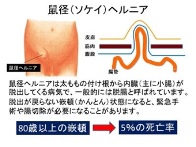 鼠径（そけい）ヘルニア