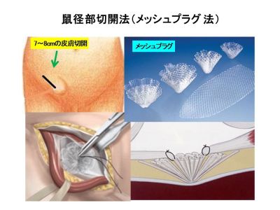 鼠径部切開法（メッシュプラグ法）