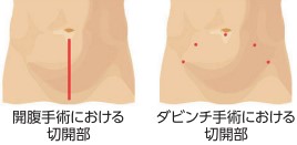 開腹手術における切開部、ダヴィンチ手術における切開部
